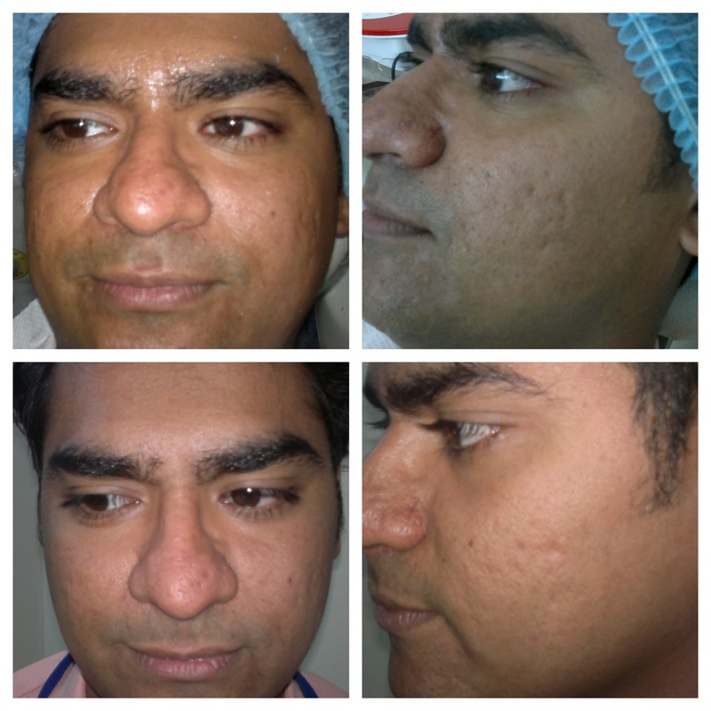Fractional Laser Skin Specialist Dubai