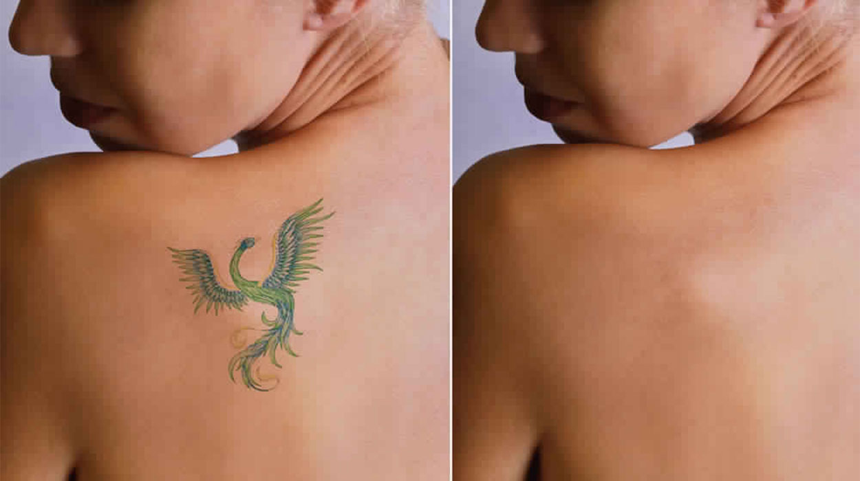 cosmcoare tattoo removal 