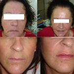 filler-botox-and-lip-augmen